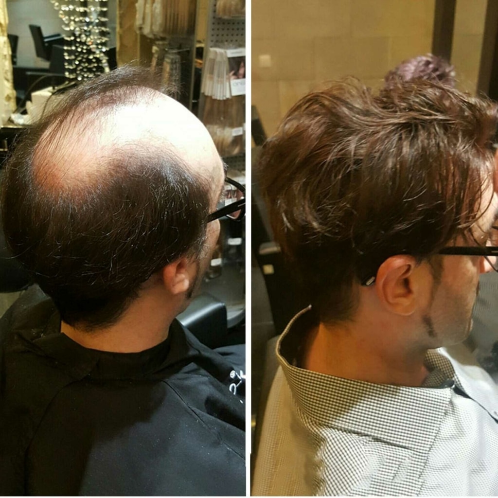 Before and after picture of hair transplant in man with dark brown hair