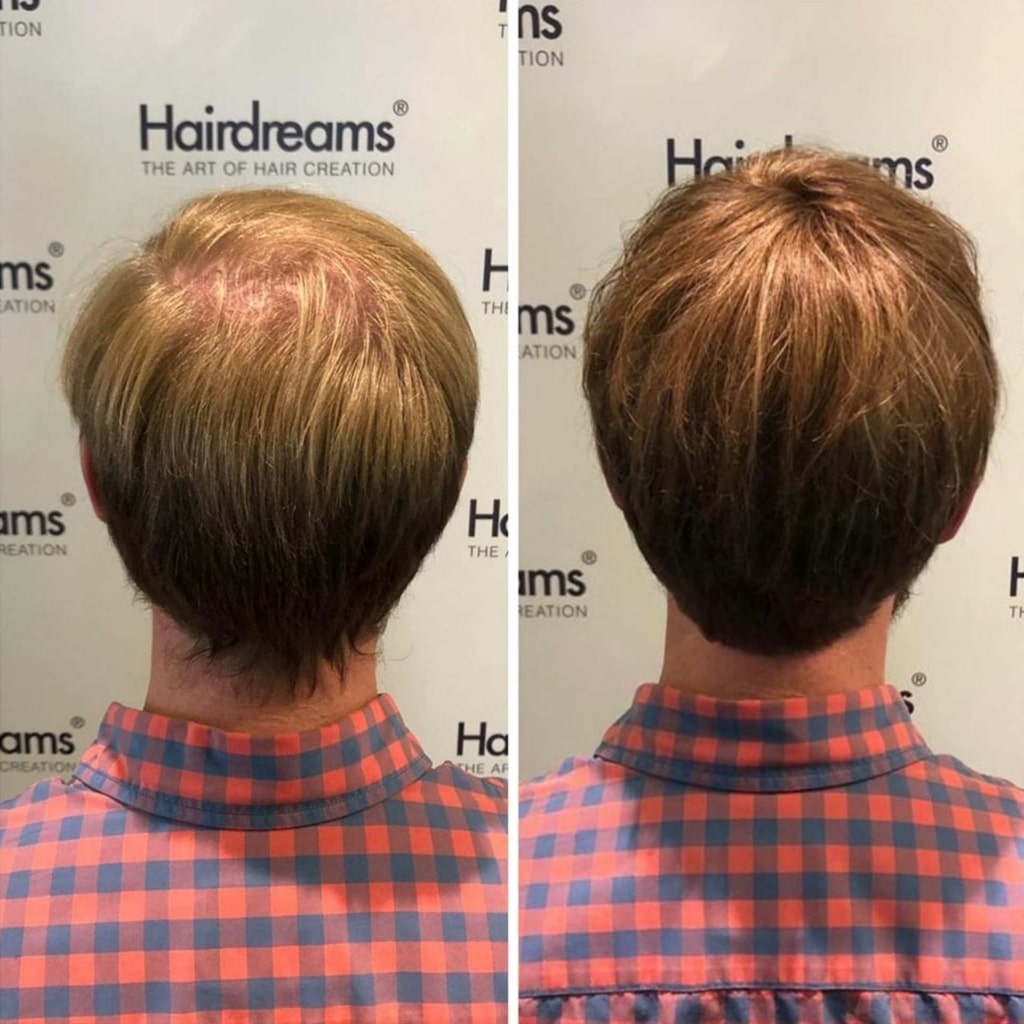 Before and after picture of hair transplant in man with brown hair