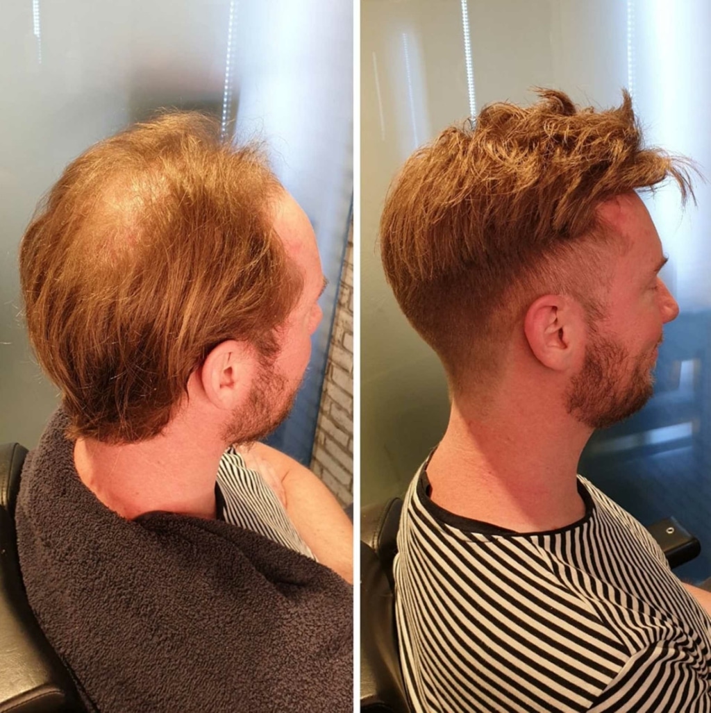 Comparison with before and after picture for hair transplantation in a man