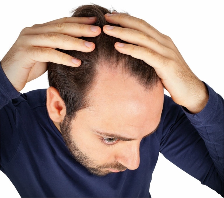 Problem with hair loss and man looking for solution with receding hairline