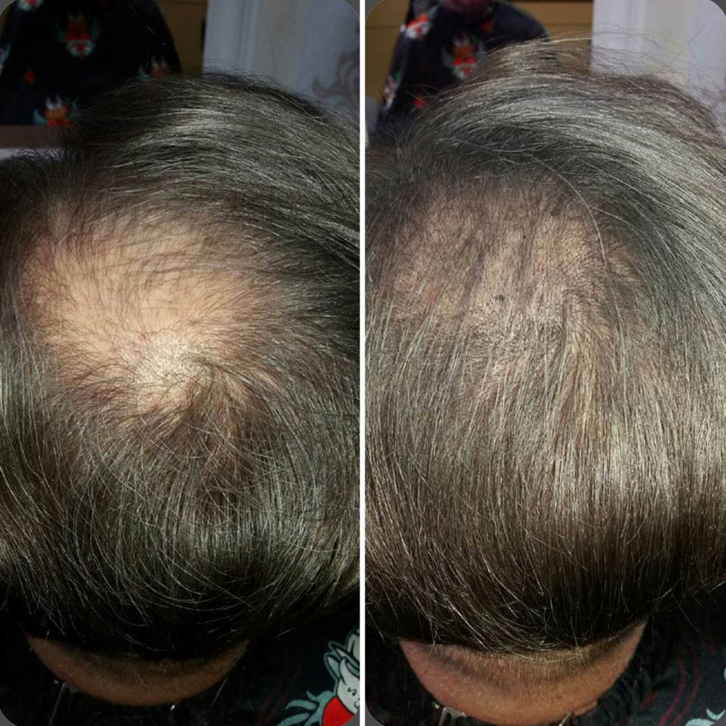 Vorher-Nachher-Bilder der Stop&Grow Haartherapie