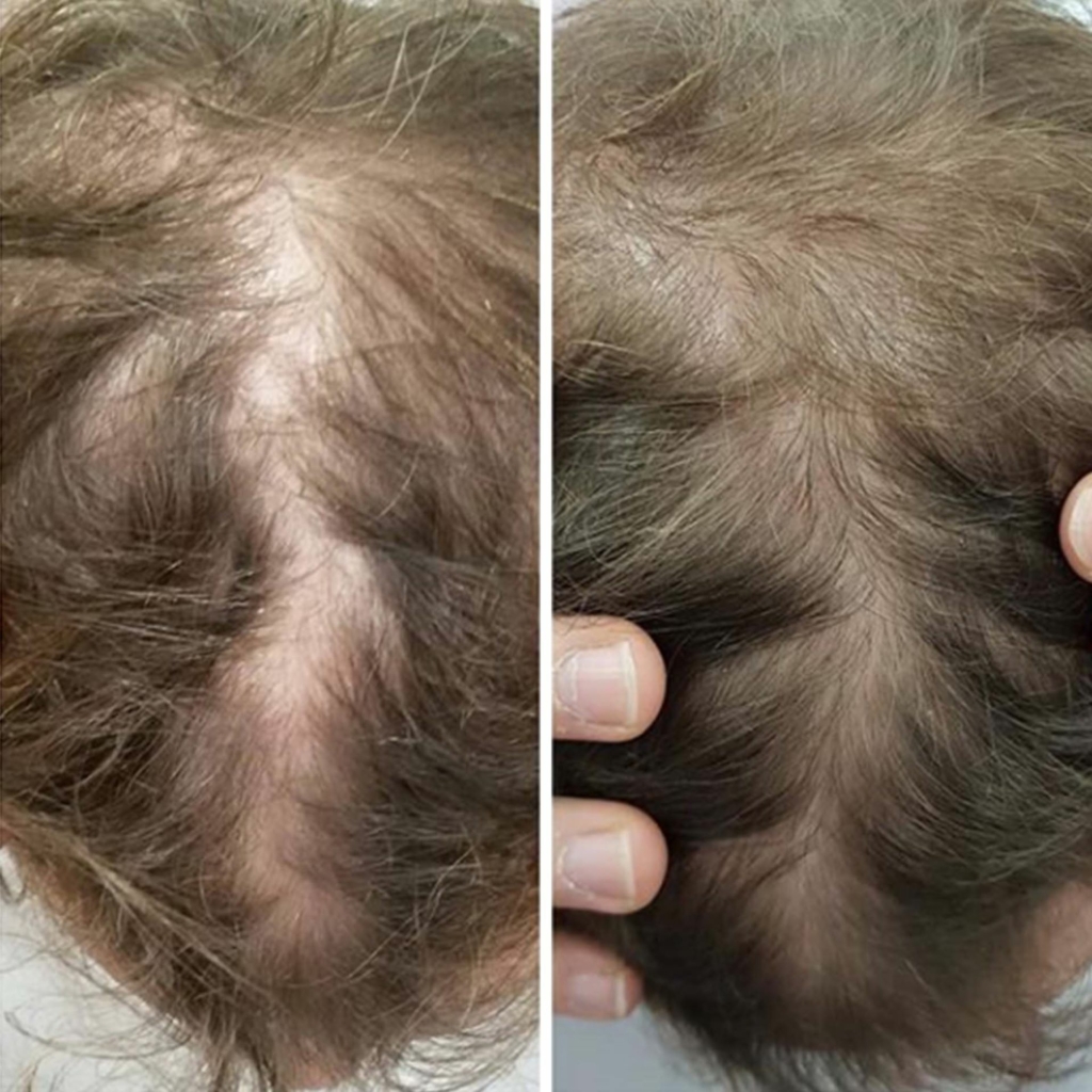 Vorher-Nachher-Fotos von einer Stop&Grow Haartherapie