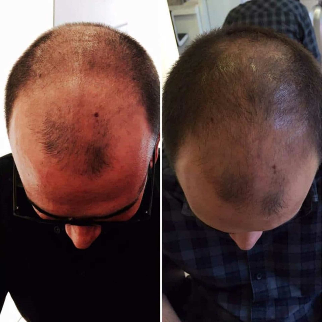 Vorher-Nachher-Bilder einer Stop&Grow Haartherapie