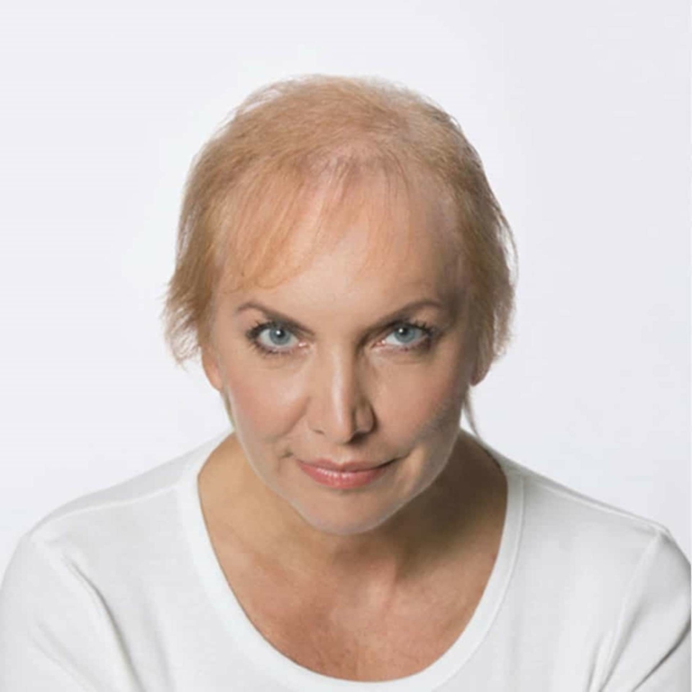 Woman with bald head
