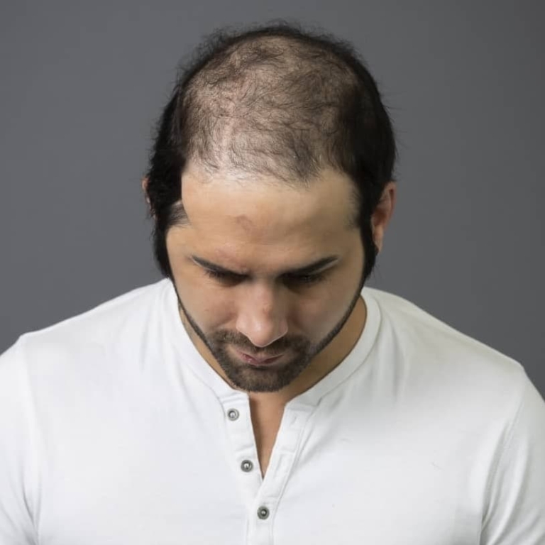 Man shows his thin hair on the top of his head.