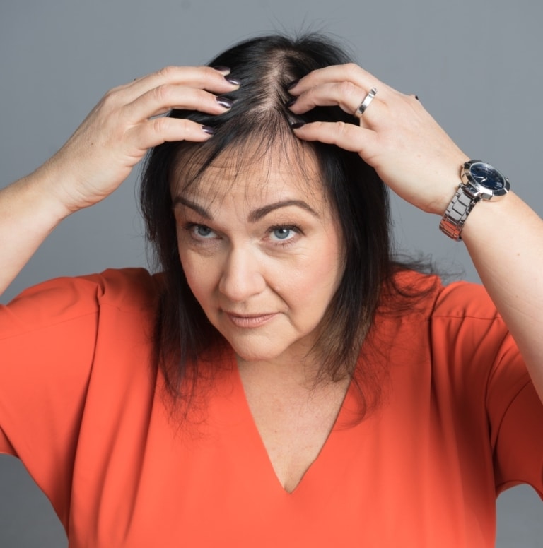 Woman shows her thin hair on the top of her head.